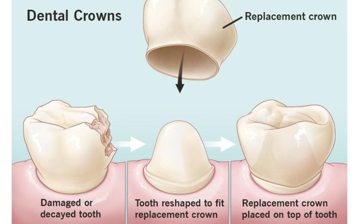 Missing Teeth? Here’s How Prosthodontics Can Help You Smile Again