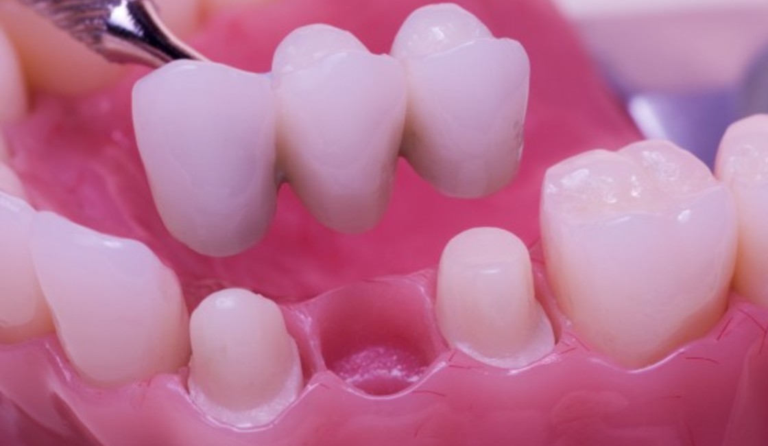 Comprehensive Guide to Prosthodontics Dentistry | Joyful Smiles Dental Studio, Greater Noida